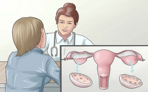 Dấu hiệu của hội chứng buồng trứng đa nang
